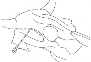 Figure 11 : Trajet du rameau cornual et lieu de pénétration de l’aiguille – Référence bibliographique n°5, page 13